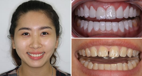 Thẩm mỹ nụ cười