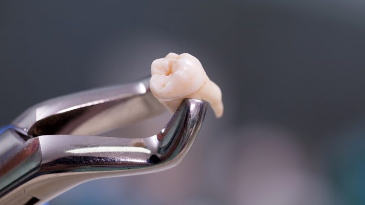 răng khôn mọc ngầm 1