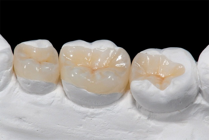 Hàn trám răng - Giải pháp phục hình răng bị sứt, mẻ, vỡ nhanh chóng 1